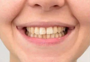 بعد تبييض الأسنان بالليزر